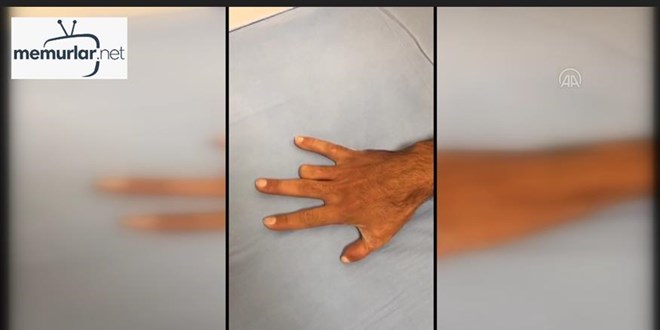 Konya'da yap�lan 'parmak nakli' literat�re girdi